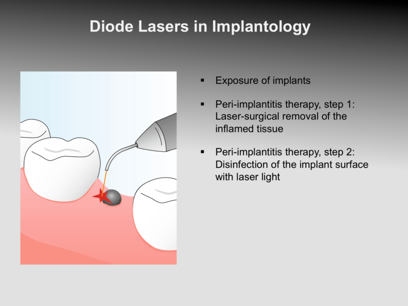 wkdl_en_08_implant_0