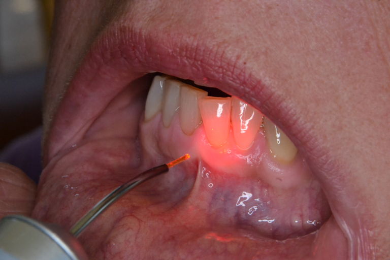 Desensitization elexxion AG dental laser dentale Diodenlaser